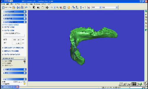 SimPlant診断を実施