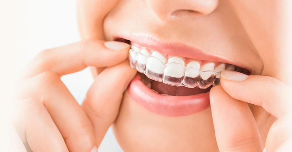 インビザラインによる歯科矯正治療を提供