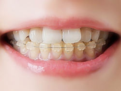 外見の向上にとどまらず、心身の健康につながる治療として矯正に取り組んでいます。