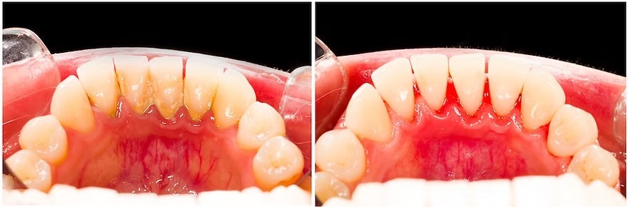 歯垢・歯石を丁寧に除去するほか、歯全体のクリーニングや着色汚れの除去にも対応しています。