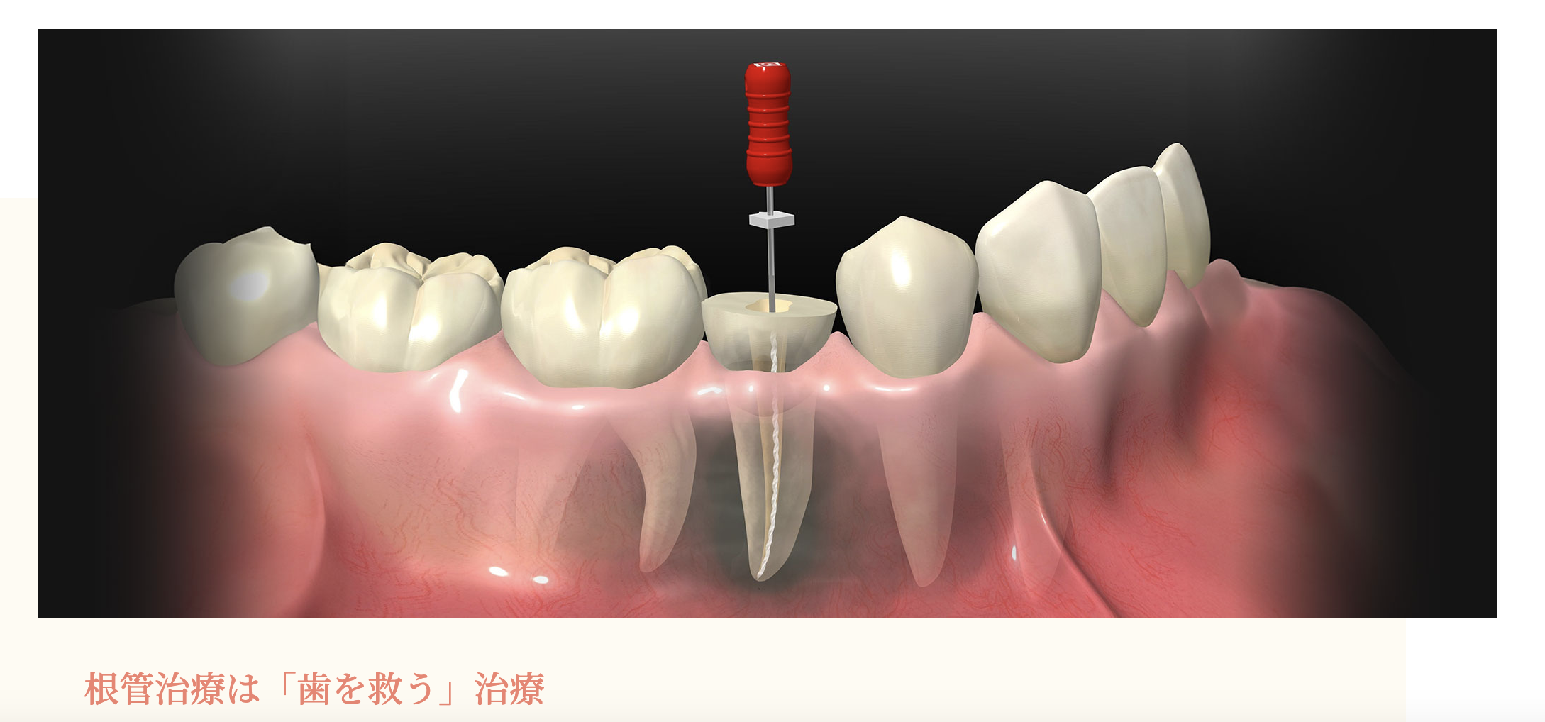 根管治療は、歯を失うリスクを軽減し、可能な限り歯を残すことを目指す重要な治療法です
