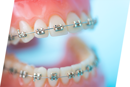 機能も美しさも叶える矯正