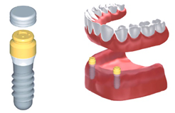 自分の歯のようにしっかり噛めるインプラント治療を提供