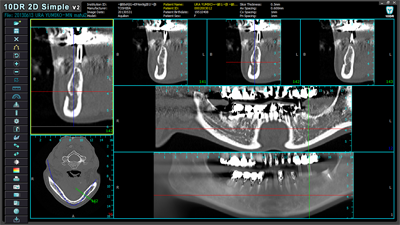 インプラントシュミレーションソフトにより正確な治療を行います