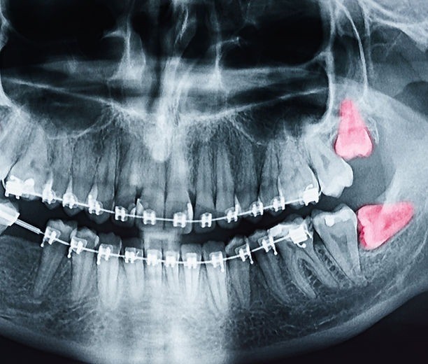 親知らずの診断と治療を通して、将来的なお口のトラブルを防ぐことを大切にしています。