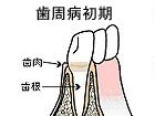 日本人の成人の約80％が何らかの段階の歯周病にあるとされています