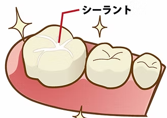 乳歯の弱点をカバーする、2つの定番虫歯予防法