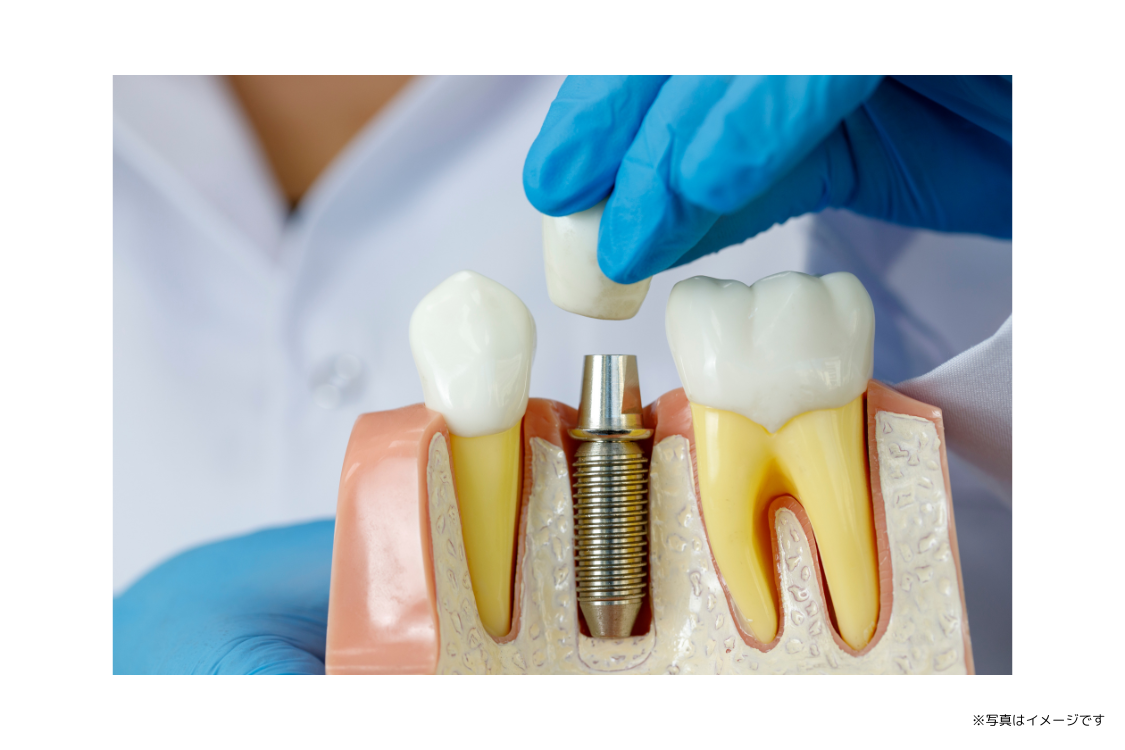 歯を失った患者様に向けて、審美性と機能性の両立を目指したインプラント治療が提供されています