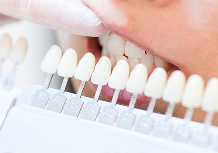 安全で効果的なホワイトニングで、美しい白い歯を実現します