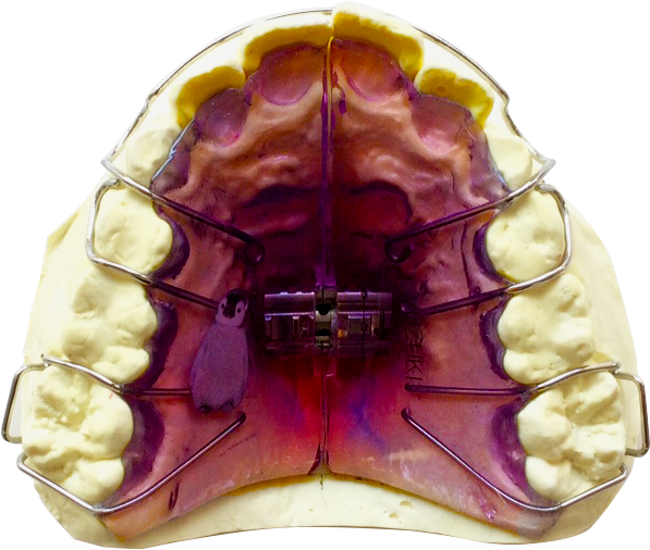 乳歯と混合歯列期の矯正に対応しております