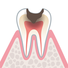 進行状況に応じて、適切な治療を施し、歯の機能を回復させることができます