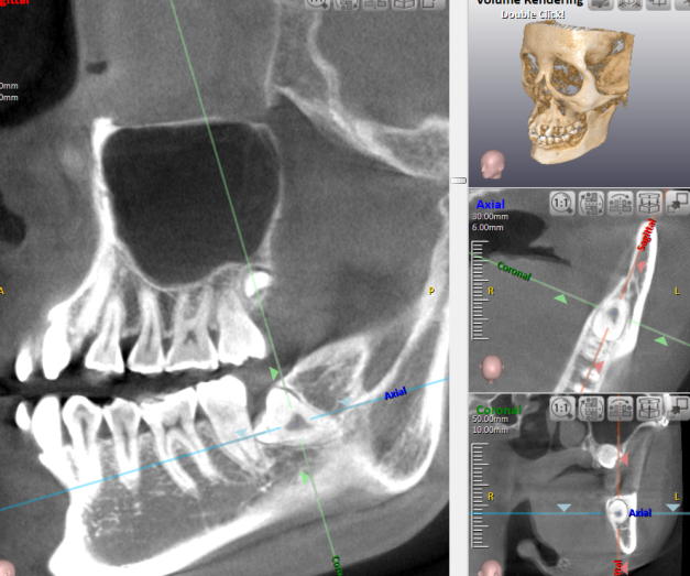 親知らずの抜歯はお任せを