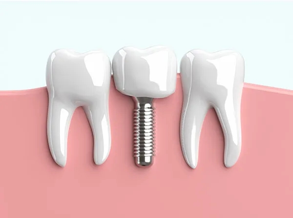 快適な毎日をインプラントで
