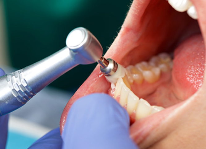 歯を長持ちさせるためのメンテナンス