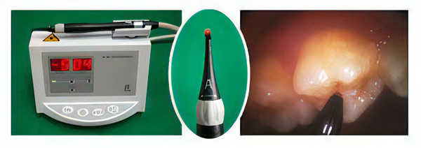 ダイアグノデントで虫歯を早期発見