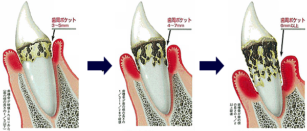 歯周病の状態に応じて治療法を使い分けています