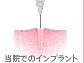 インプラント治療の大きな特徴のひとつが、ドリルや骨移植をほとんど必要としない画期的な術式を採用している点です