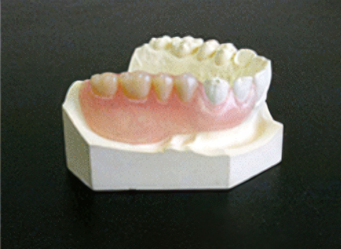 弾性樹脂義歯の普及が進んでいます