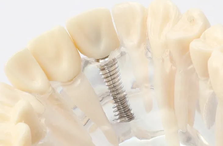 世界基準の技術を活かした信頼のインプラント治療