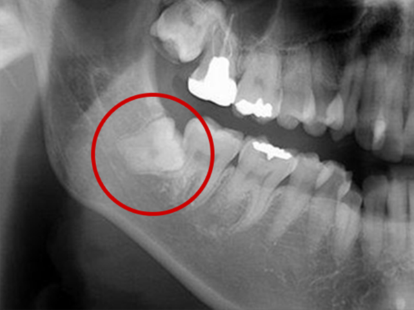 難しい親知らずの抜歯も行います