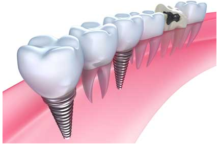 口腔外科治療にも対応している強みを活かし、インプラント治療を行っています