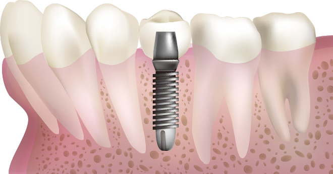 溝口歯科医院ではCT撮影を行い、より安全なインプラント治療を行います