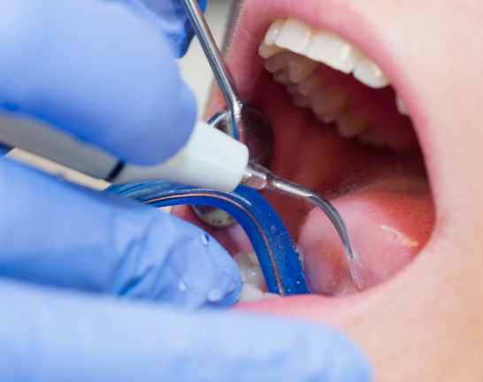 歯周病を治療し、歯を守りましょう