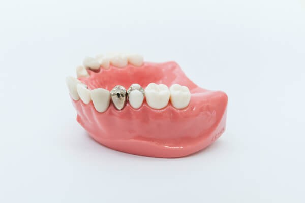 最適な入れ歯をご提案いたします