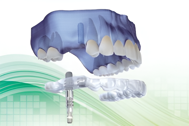 安全かつ効果的なインプラント治療