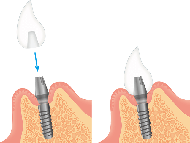 自分の本当の歯のように強く咬むことができ、機能的にも審美的にも優れた治療法