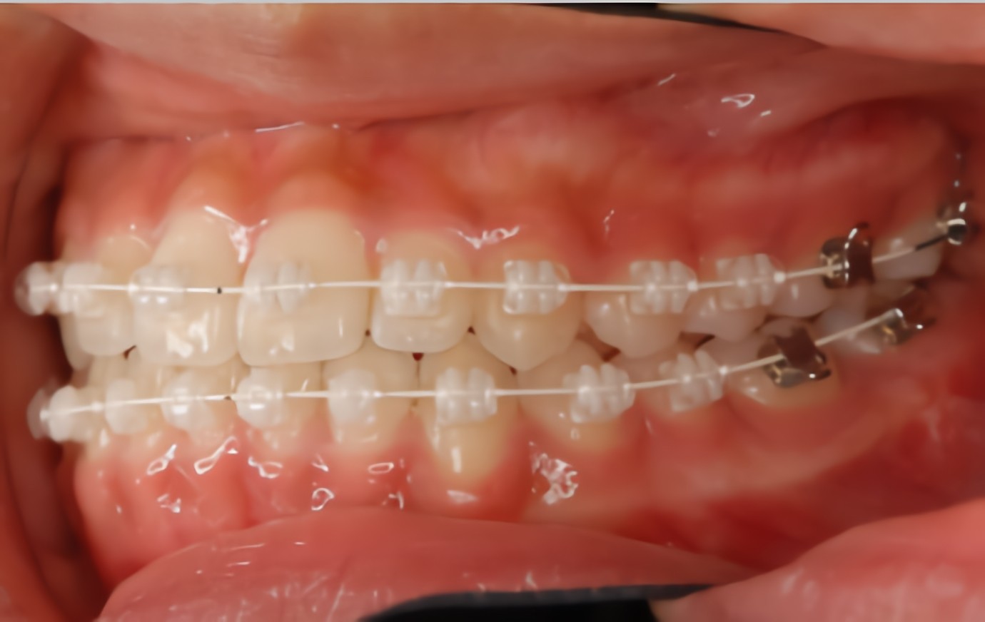 目立たない矯正装置にも対応しています