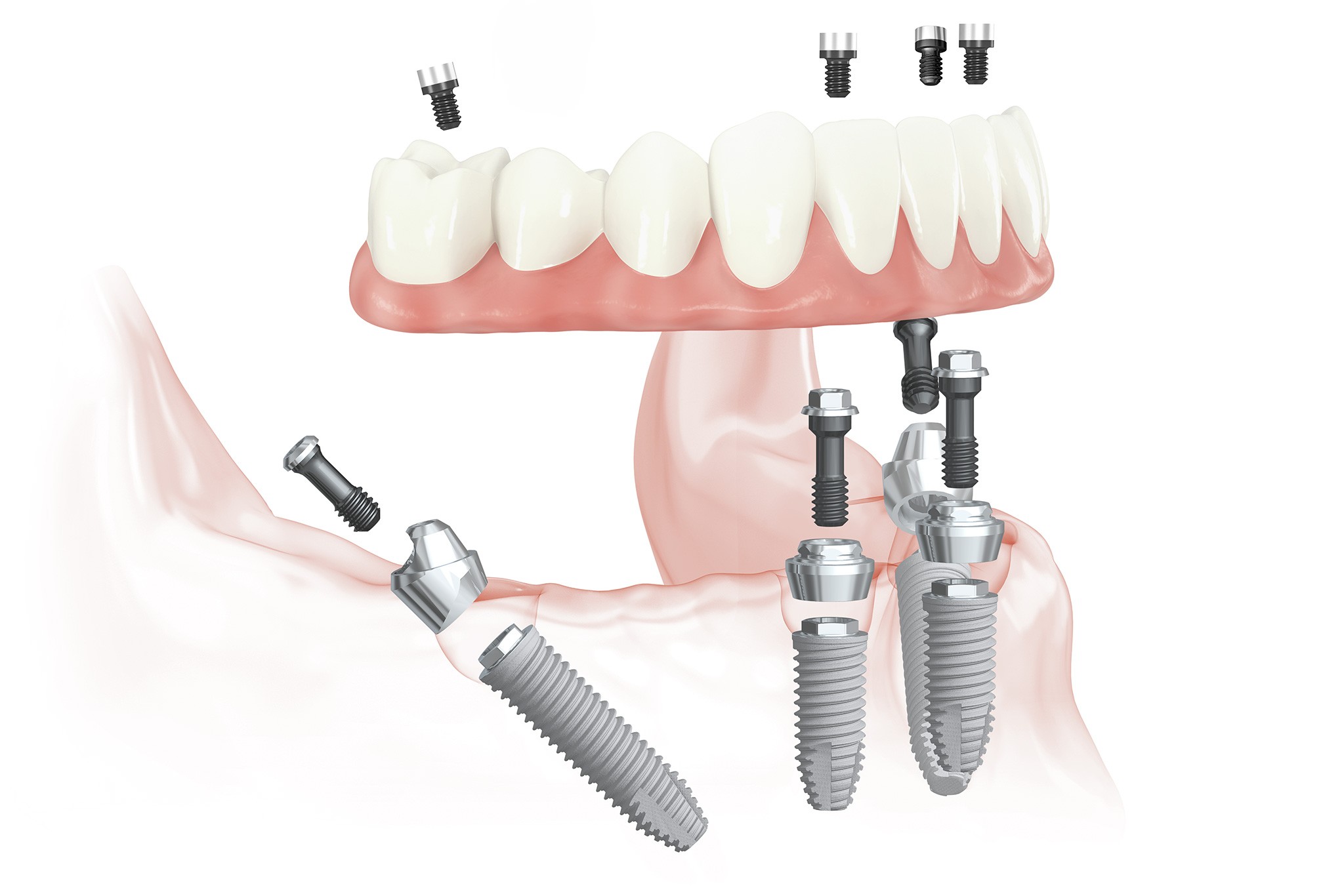 世界トップシェアのノーベルバイオケア社製インプラントを採用しています