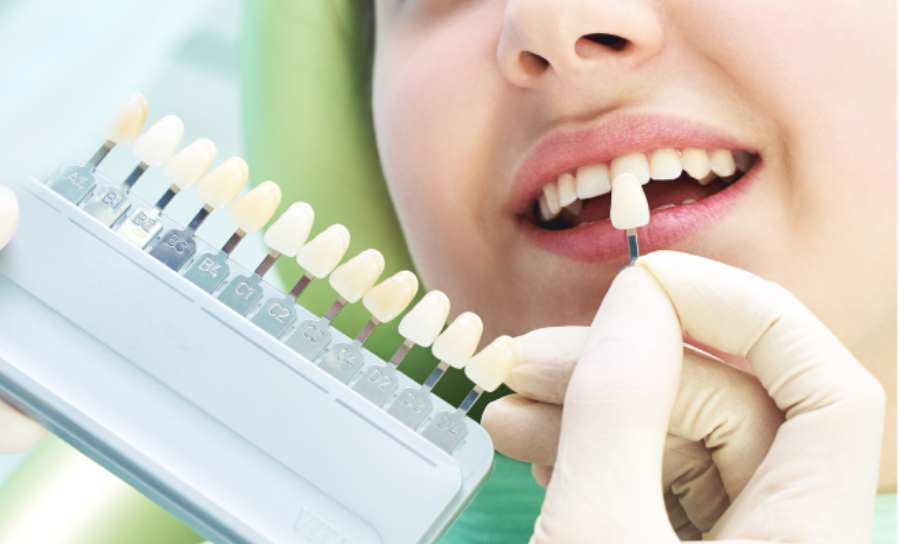 自宅でのホワイトニングは、専用のマウストレー装着時間は一日1回で2時間以内装着