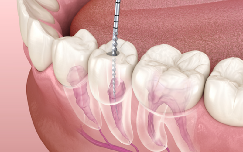 エンジンリーマー・Ni-Tファイルを使って精密な治療