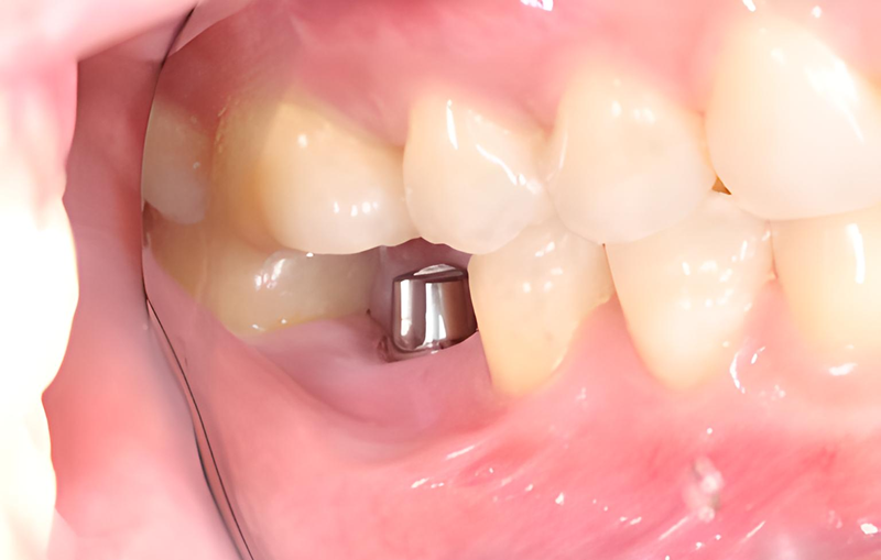 顎の骨に固定されるインプラントで自然な噛み心地と審美性を実現
