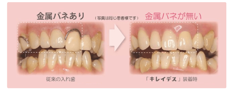 目立たずしっかり噛める義歯