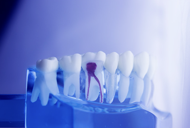 根管治療を行い、できる限り歯を残す治療を目指しています