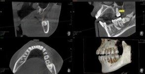 歯科用CTを使用します