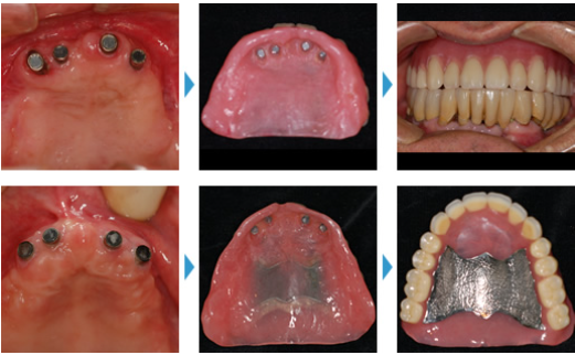 患者様のお口の状態に合った義歯を作製します