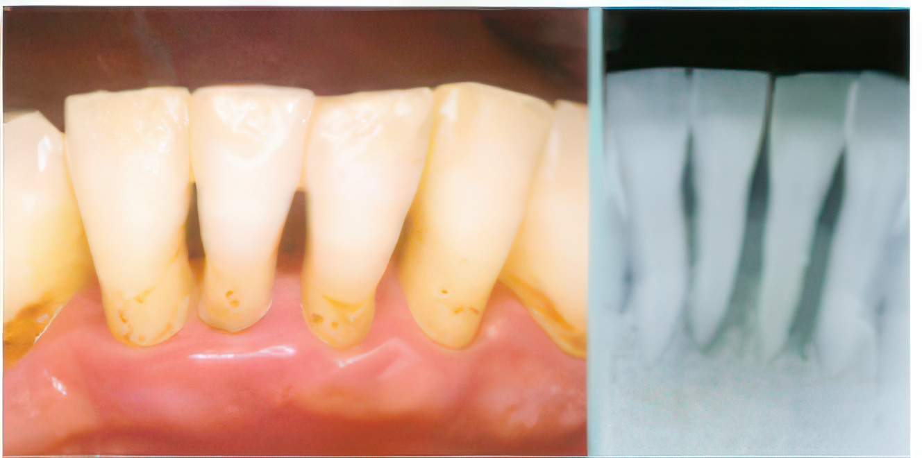 中等度歯周炎の症例