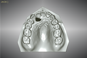 治療後の歯並び