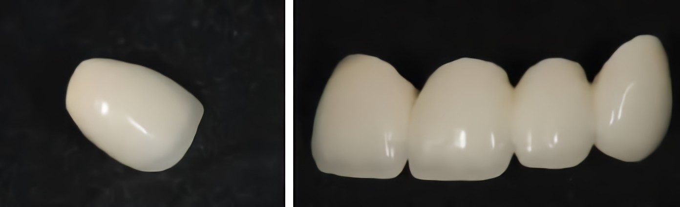 ジルコニアクラウン