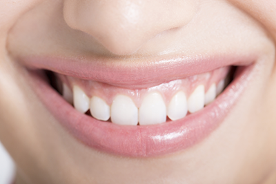 ホワイトニングに対応しています