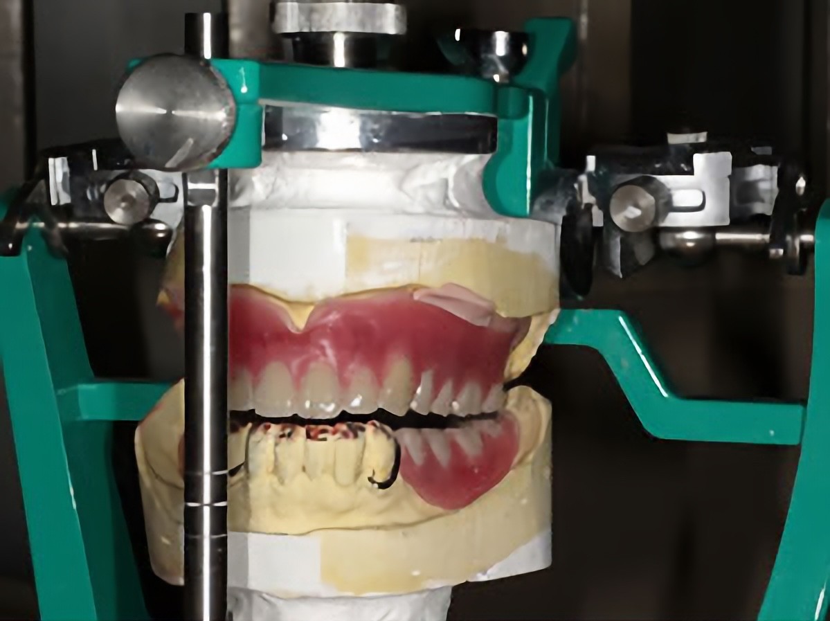 咬合器でのかみ合わせの調整