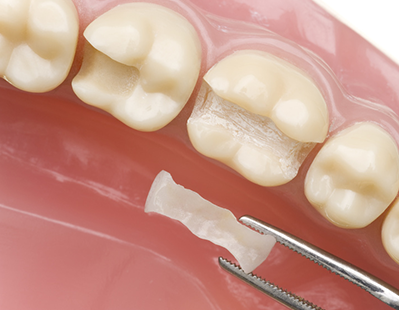 天然歯のような自然な仕上がりで、笑顔に自信を