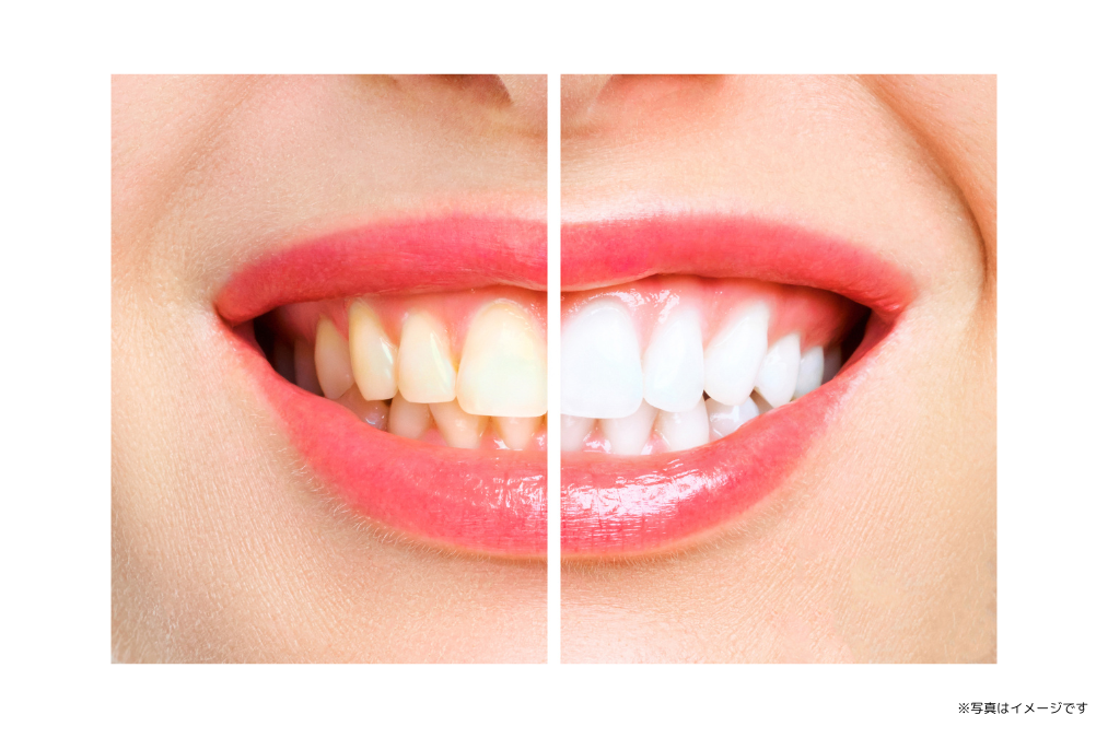 患者様一人ひとりのご希望に応じたホワイトニングプランを提案しています