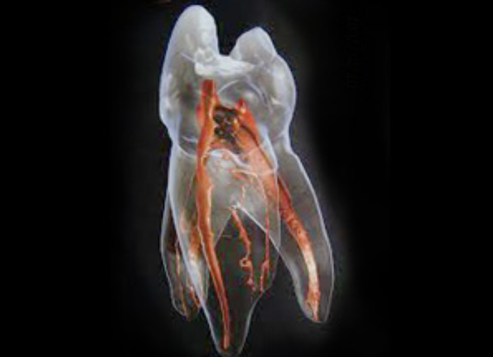 根管治療を適切に行うことで歯を抜かずに保存できる可能性があります