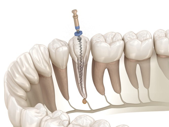 治療後はファイバーコアで補強し、歯根破折のリスク軽減にも配慮しています