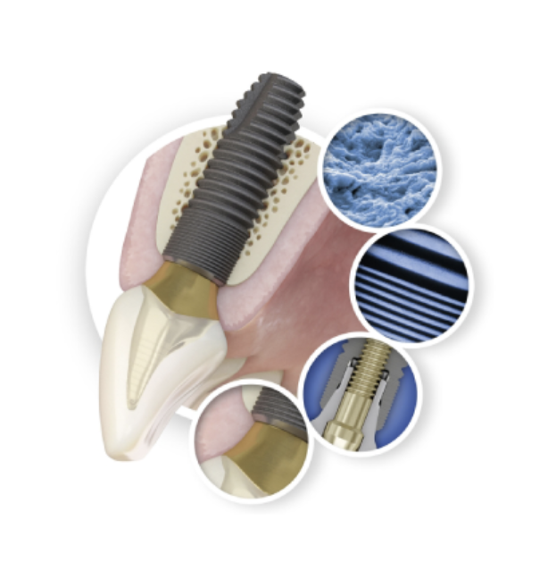 失われた歯の機能と見た目を自然に再現するインプラント治療を提供しています