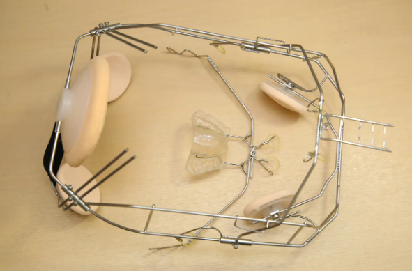 小児矯正のひとつです